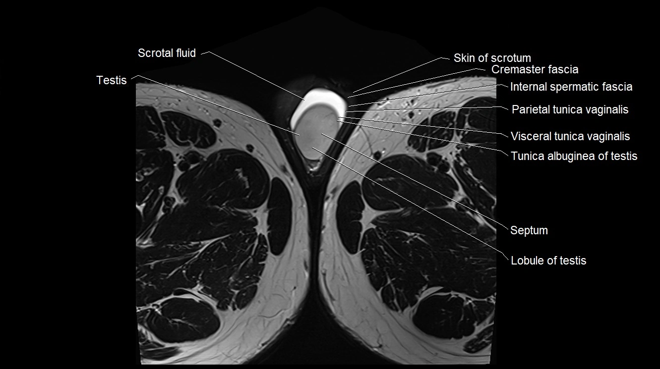 MRI 3T scrotum and penis axial cross sectional anatomy image 39.webp